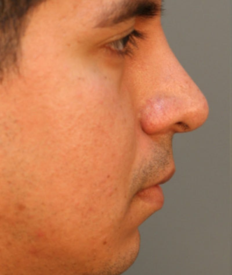 Revision Rhinoplasty Before & After Gallery - Patient 108191456 - Image 1