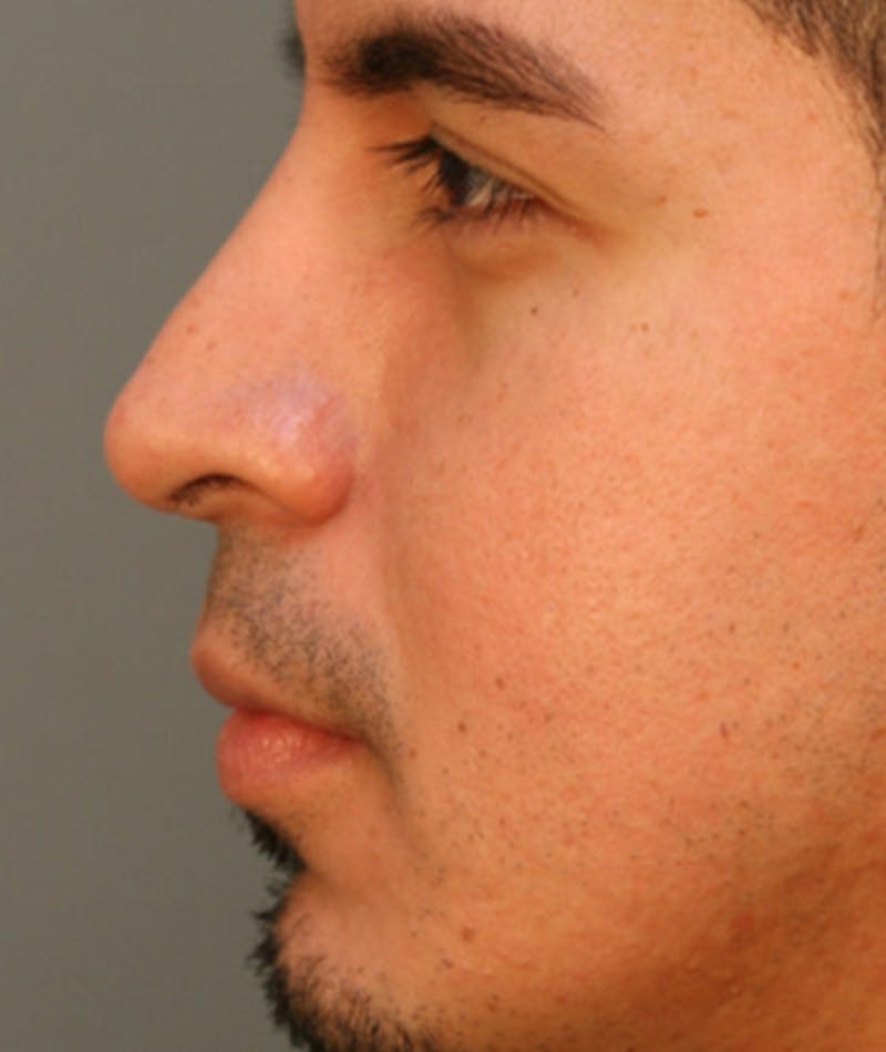 Revision Rhinoplasty Before & After Gallery - Patient 108191456 - Image 2