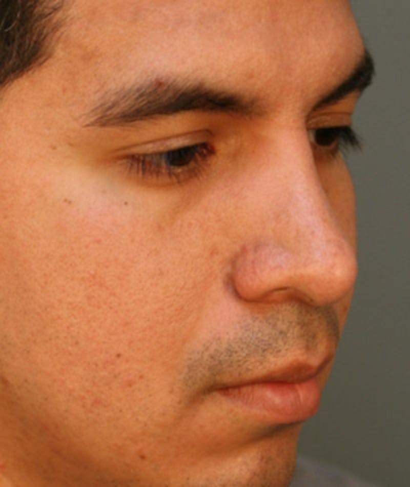 Revision Rhinoplasty Before & After Gallery - Patient 108191456 - Image 5