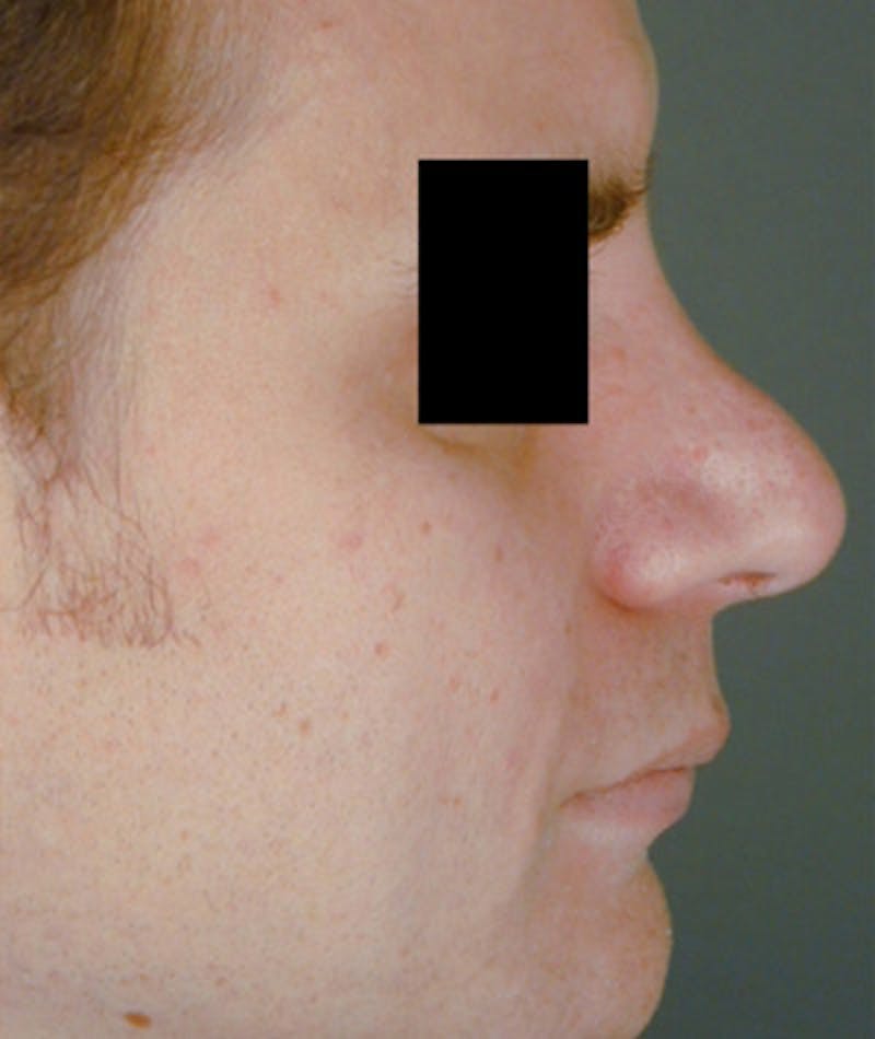 Revision Rhinoplasty Before & After Gallery - Patient 108191463 - Image 1
