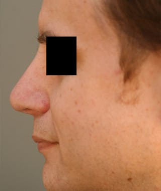 Revision Rhinoplasty Before & After Gallery - Patient 108191463 - Image 2