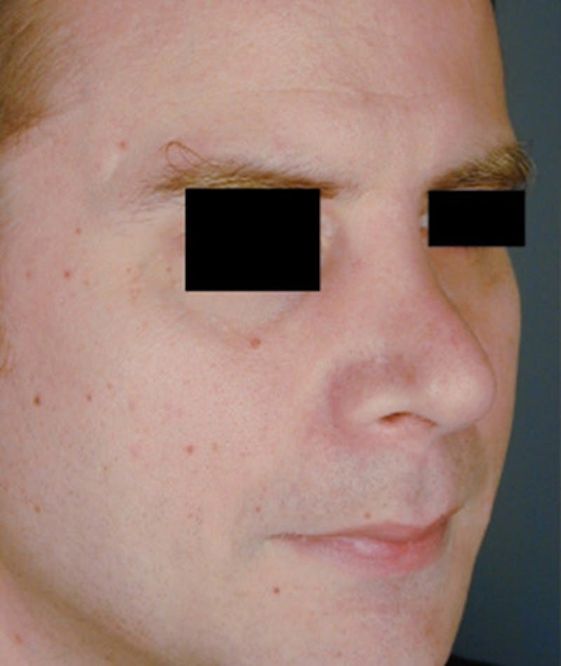 Revision Rhinoplasty Before & After Gallery - Patient 108191463 - Image 3