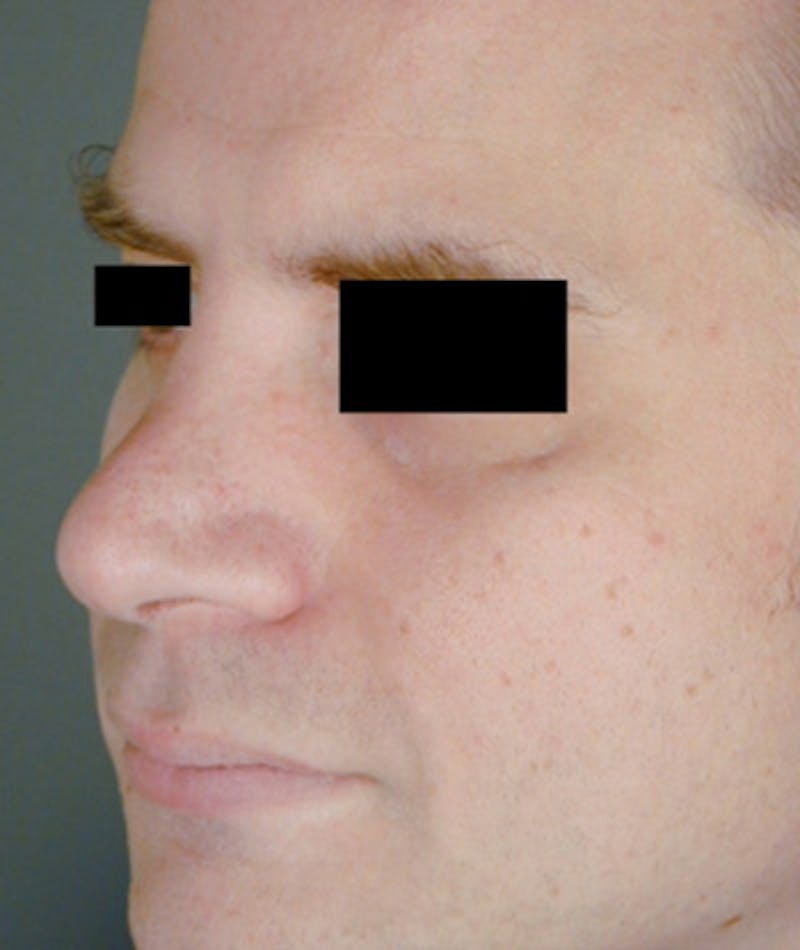 Revision Rhinoplasty Before & After Gallery - Patient 108191463 - Image 5