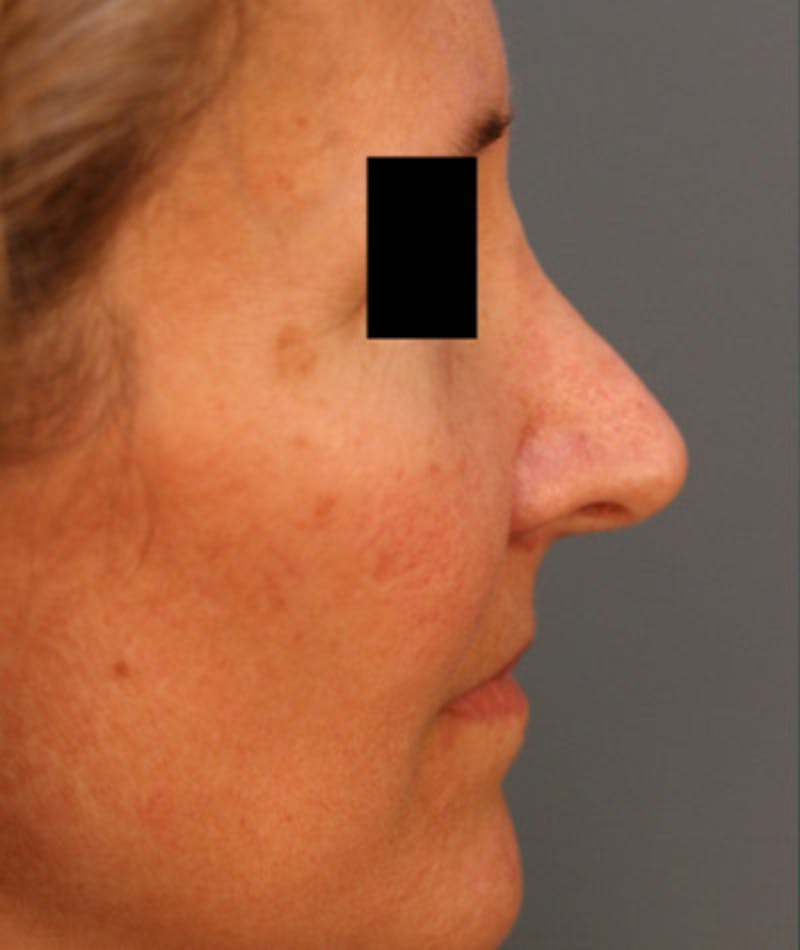 Revision Rhinoplasty Before & After Gallery - Patient 108191480 - Image 1