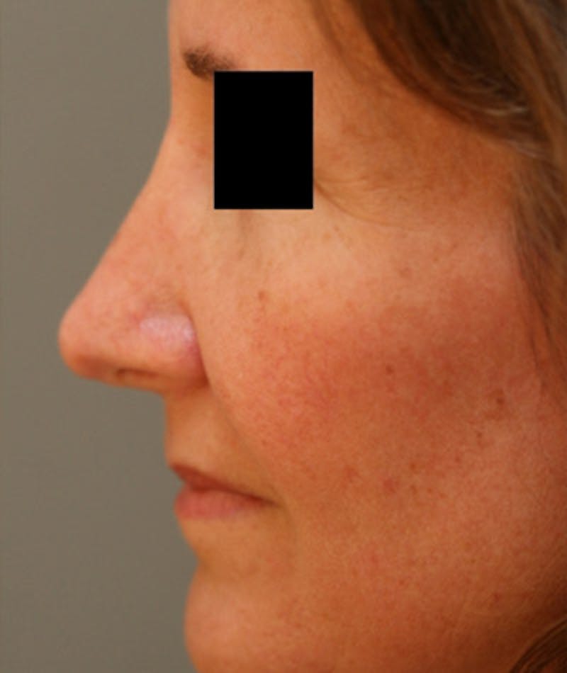 Revision Rhinoplasty Gallery - Patient 108191480 - Image 2