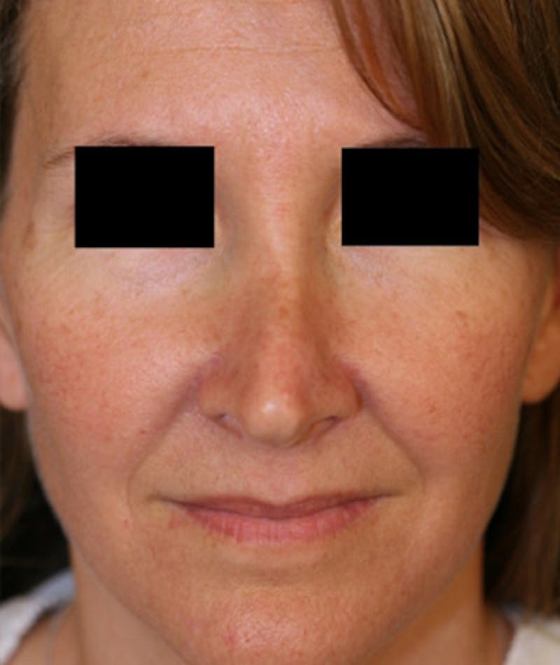 Revision Rhinoplasty Before & After Gallery - Patient 108191480 - Image 3