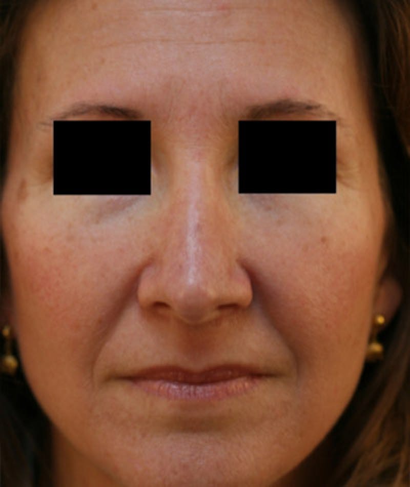 Revision Rhinoplasty Before & After Gallery - Patient 108191480 - Image 4