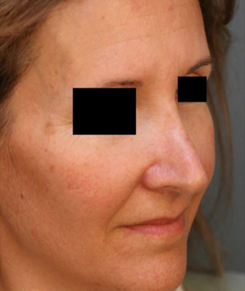 Revision Rhinoplasty Before & After Gallery - Patient 108191480 - Image 5