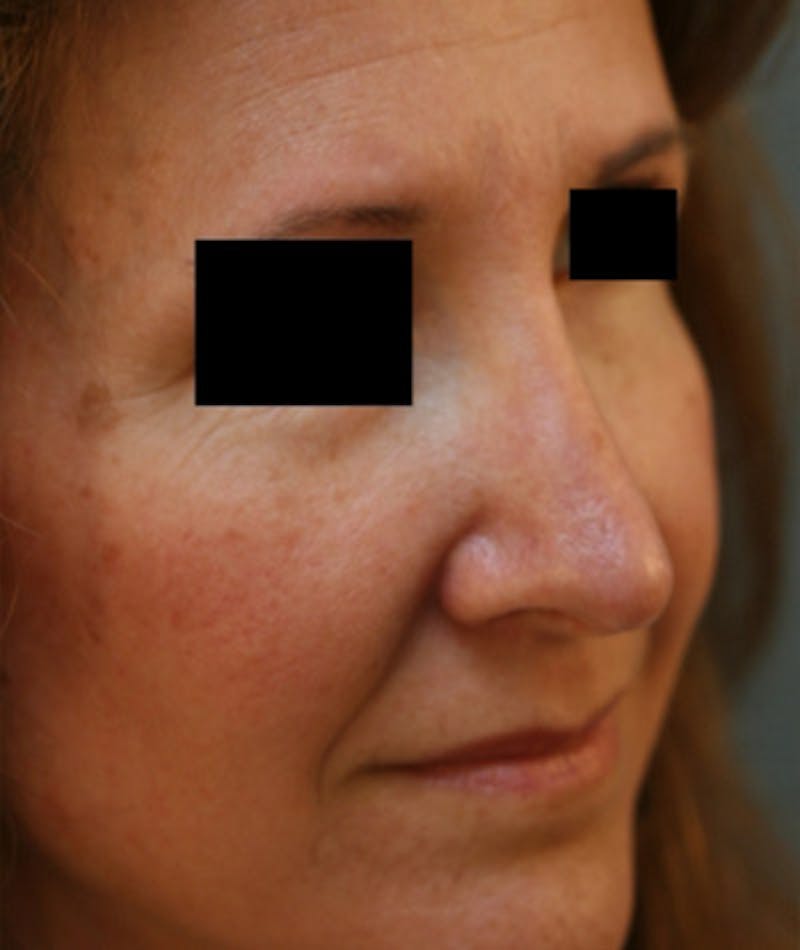 Revision Rhinoplasty Before & After Gallery - Patient 108191480 - Image 6