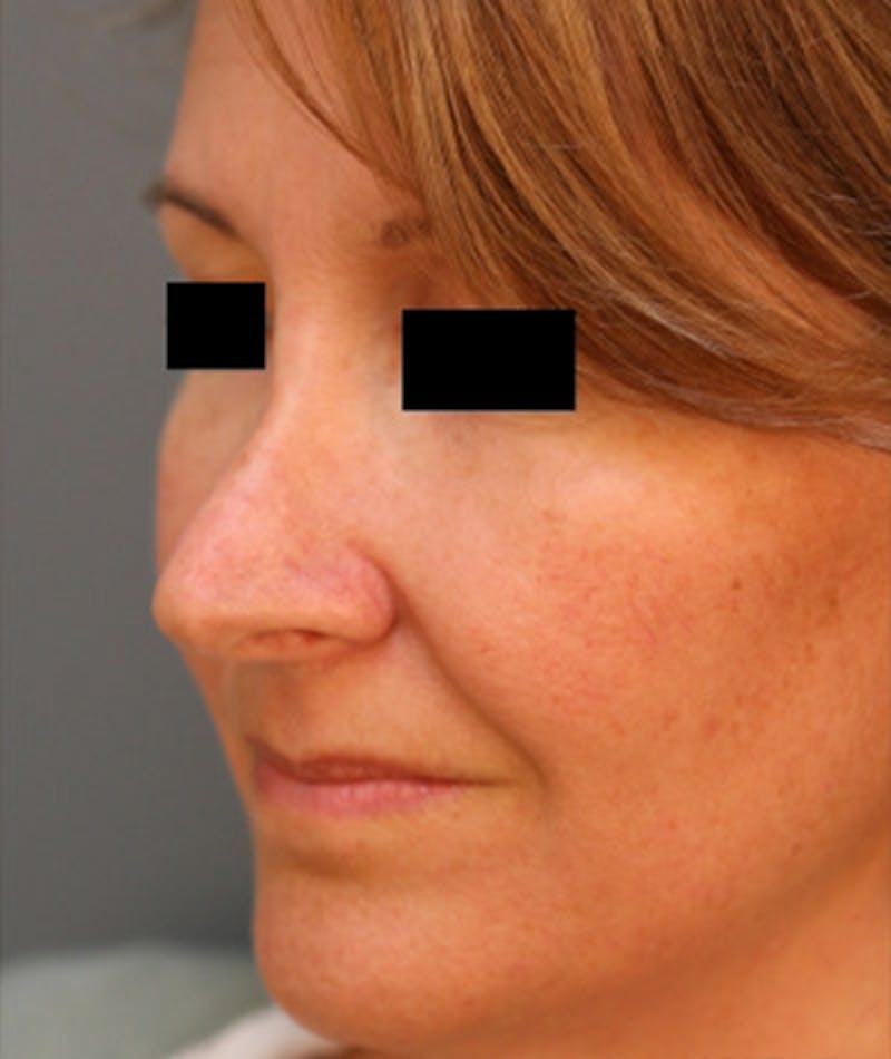 Revision Rhinoplasty Gallery - Patient 108191480 - Image 7
