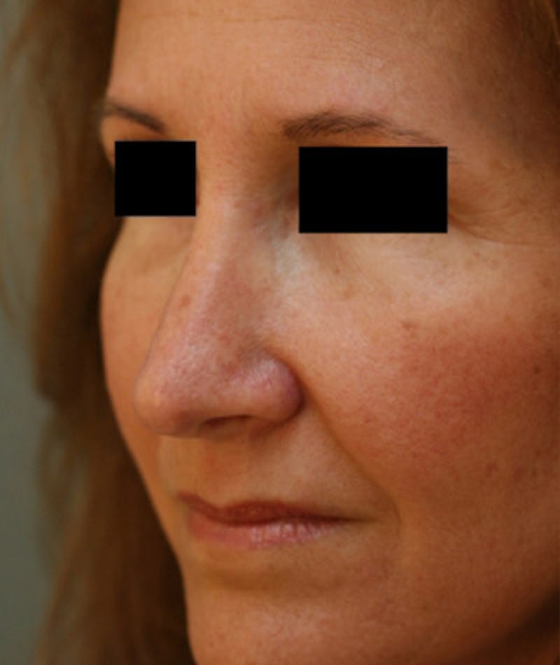 Revision Rhinoplasty Before & After Gallery - Patient 108191480 - Image 8