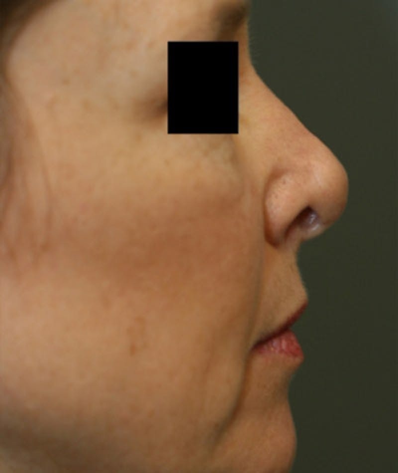 Revision Rhinoplasty Before & After Gallery - Patient 108191499 - Image 1