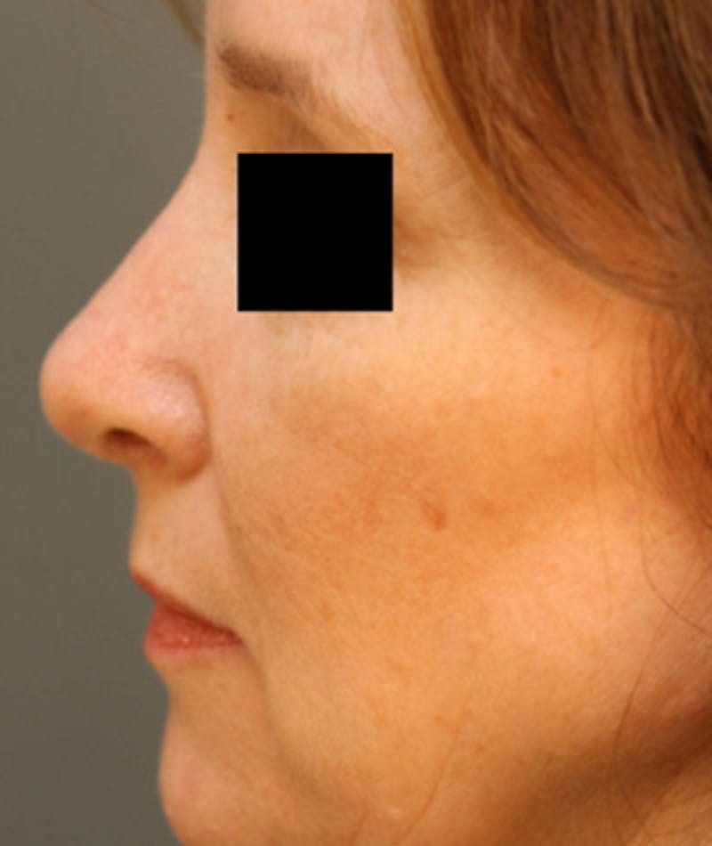 Revision Rhinoplasty Before & After Gallery - Patient 108191499 - Image 2