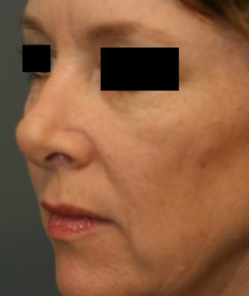 Revision Rhinoplasty Gallery - Patient 108191499 - Image 3