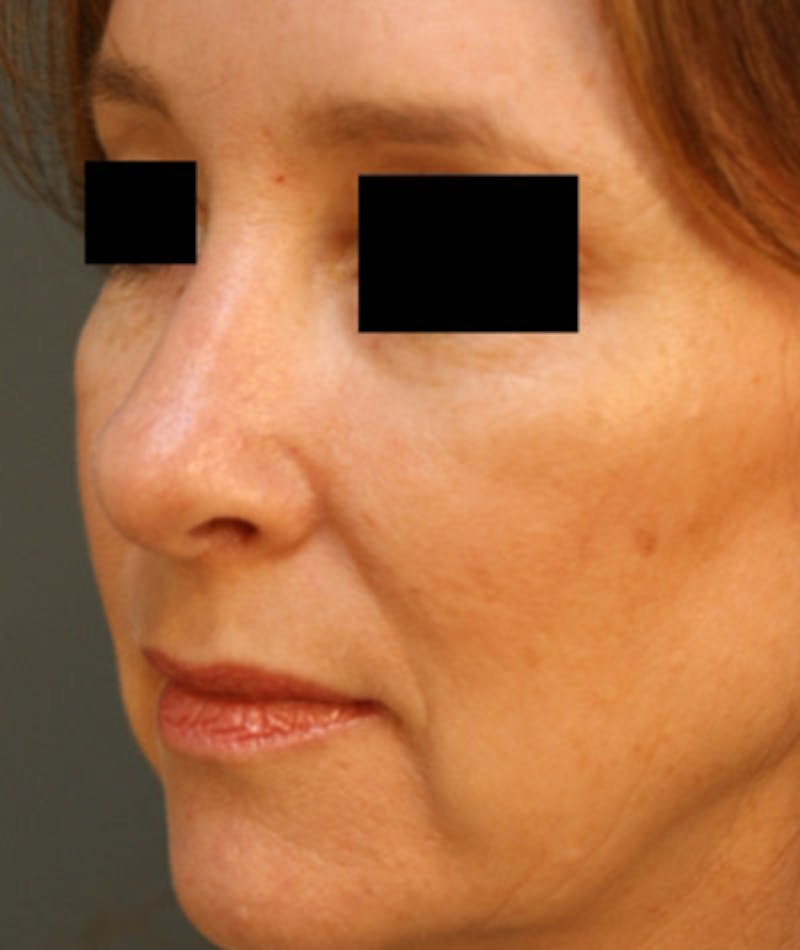 Revision Rhinoplasty Before & After Gallery - Patient 108191499 - Image 4