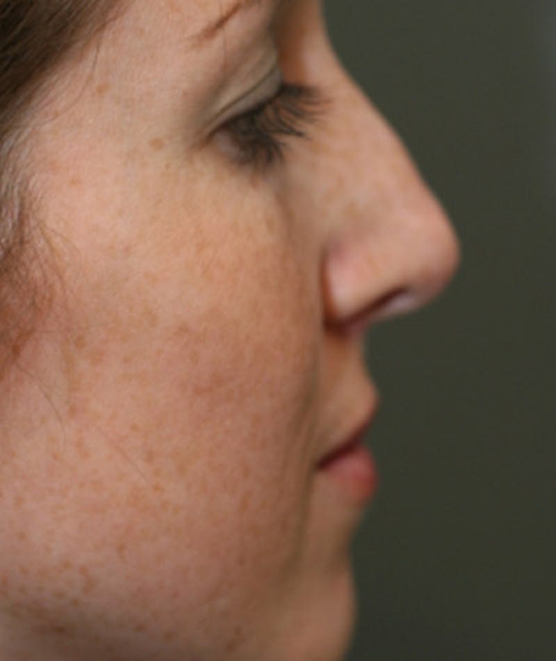 Revision Rhinoplasty Gallery - Patient 108191504 - Image 1
