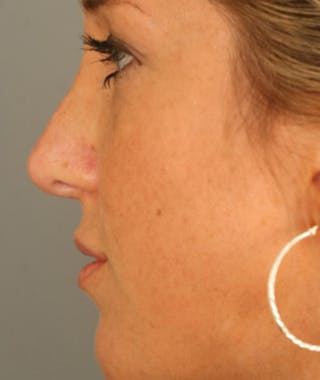 Revision Rhinoplasty Before & After Gallery - Patient 108191504 - Image 2