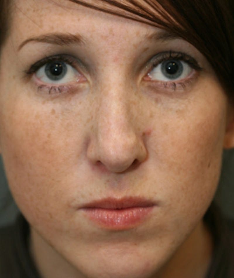Revision Rhinoplasty Before & After Gallery - Patient 108191504 - Image 3