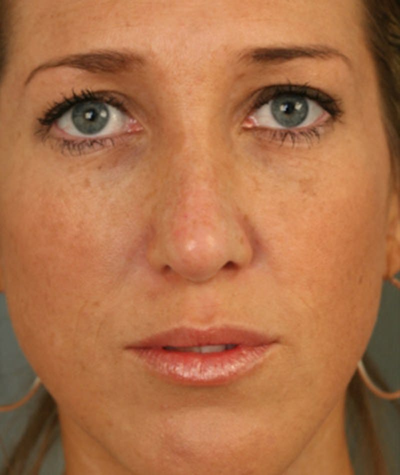 Revision Rhinoplasty Before & After Gallery - Patient 108191504 - Image 4