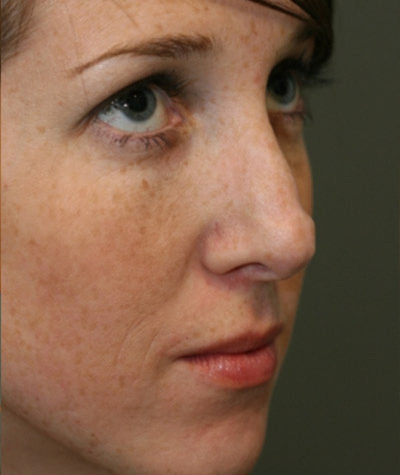Revision Rhinoplasty Before & After Gallery - Patient 108191504 - Image 5