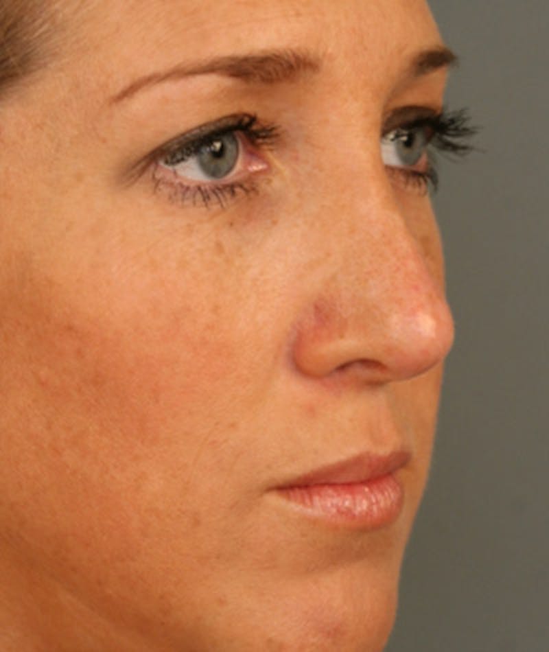 Revision Rhinoplasty Before & After Gallery - Patient 108191504 - Image 6