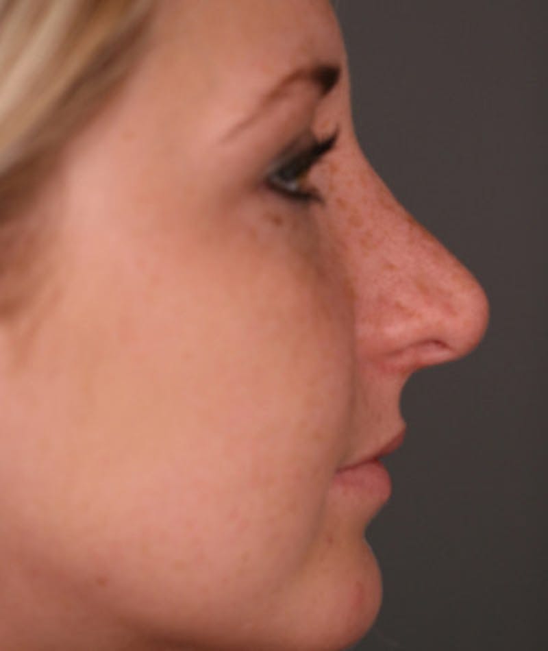 Revision Rhinoplasty Before & After Gallery - Patient 108191512 - Image 1