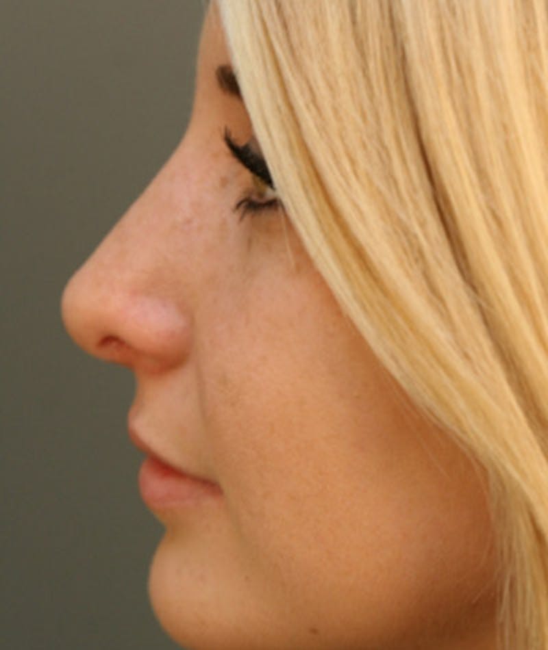 Revision Rhinoplasty Before & After Gallery - Patient 108191512 - Image 2