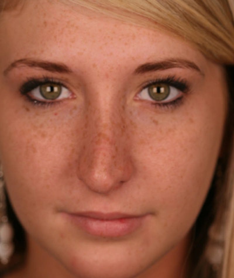 Revision Rhinoplasty Before & After Gallery - Patient 108191512 - Image 3