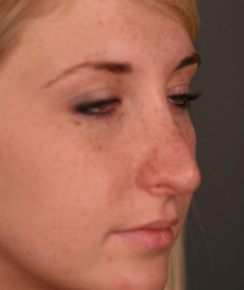 Revision Rhinoplasty Before & After Gallery - Patient 108191512 - Image 5