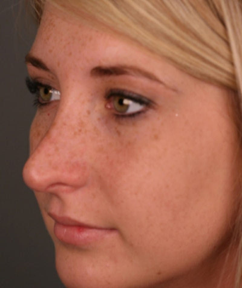 Revision Rhinoplasty Before & After Gallery - Patient 108191512 - Image 7