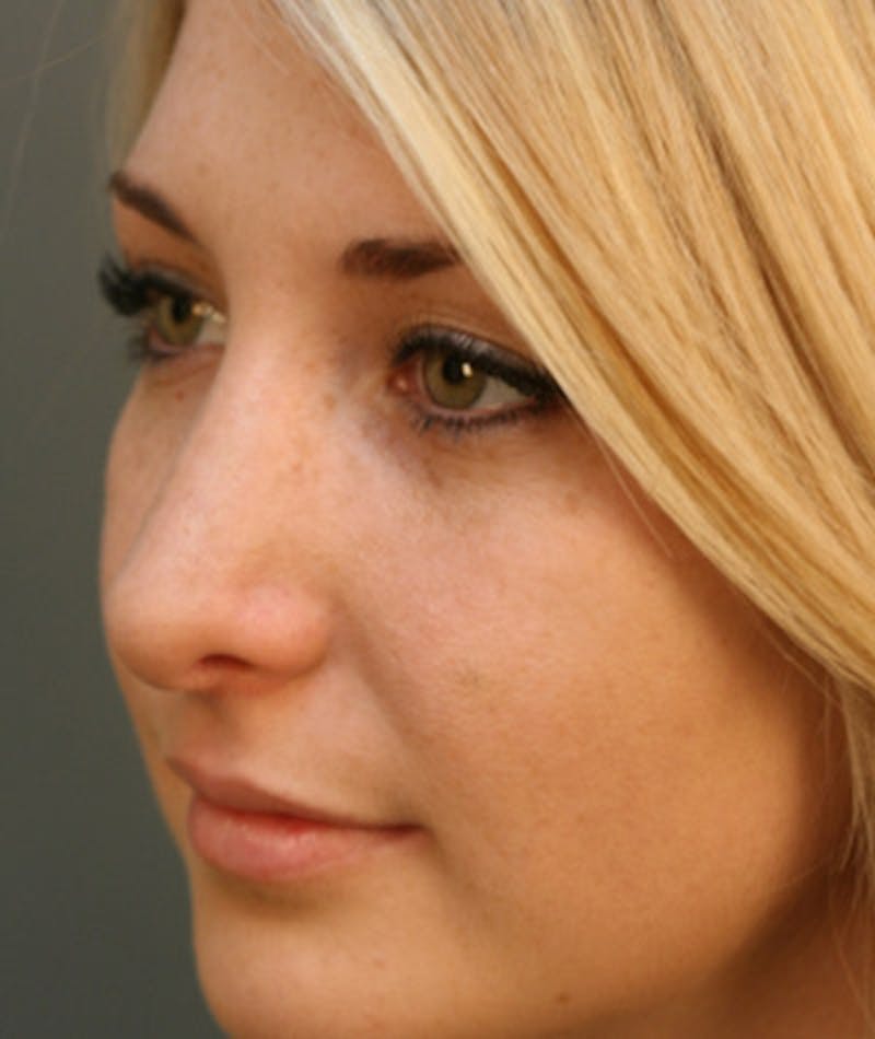 Revision Rhinoplasty Before & After Gallery - Patient 108191512 - Image 8