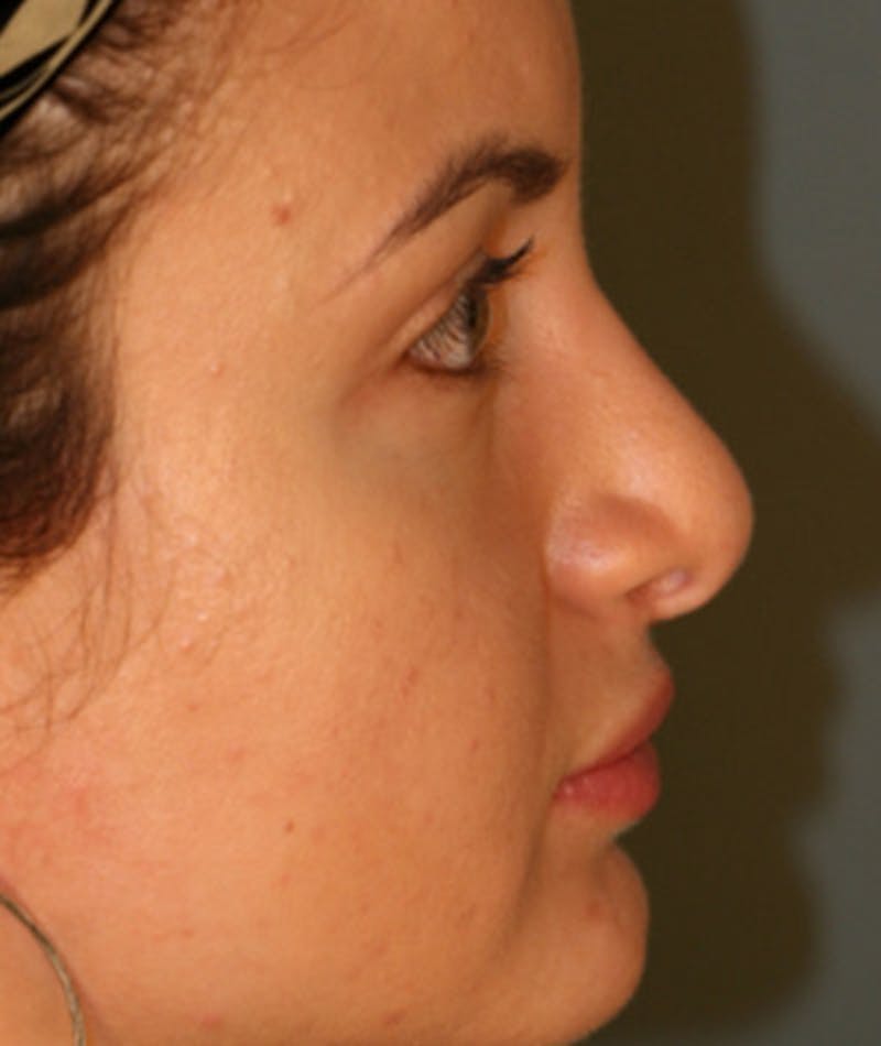 Revision Rhinoplasty Before & After Gallery - Patient 108191517 - Image 1