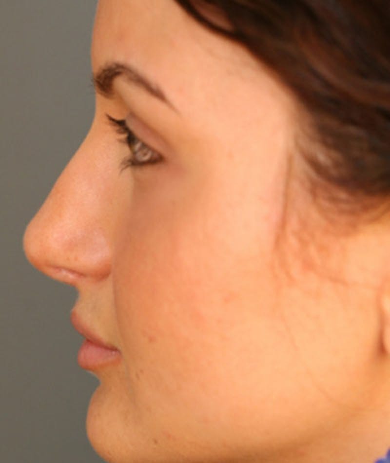 Revision Rhinoplasty Before & After Gallery - Patient 108191517 - Image 2