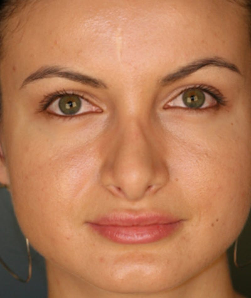 Revision Rhinoplasty Before & After Gallery - Patient 108191517 - Image 3