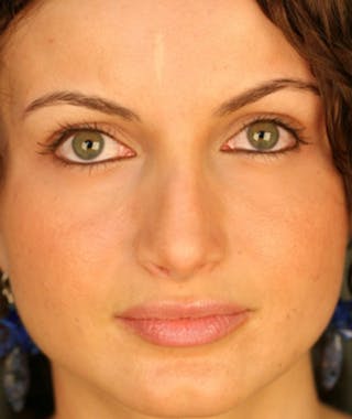 Revision Rhinoplasty Before & After Gallery - Patient 108191517 - Image 4