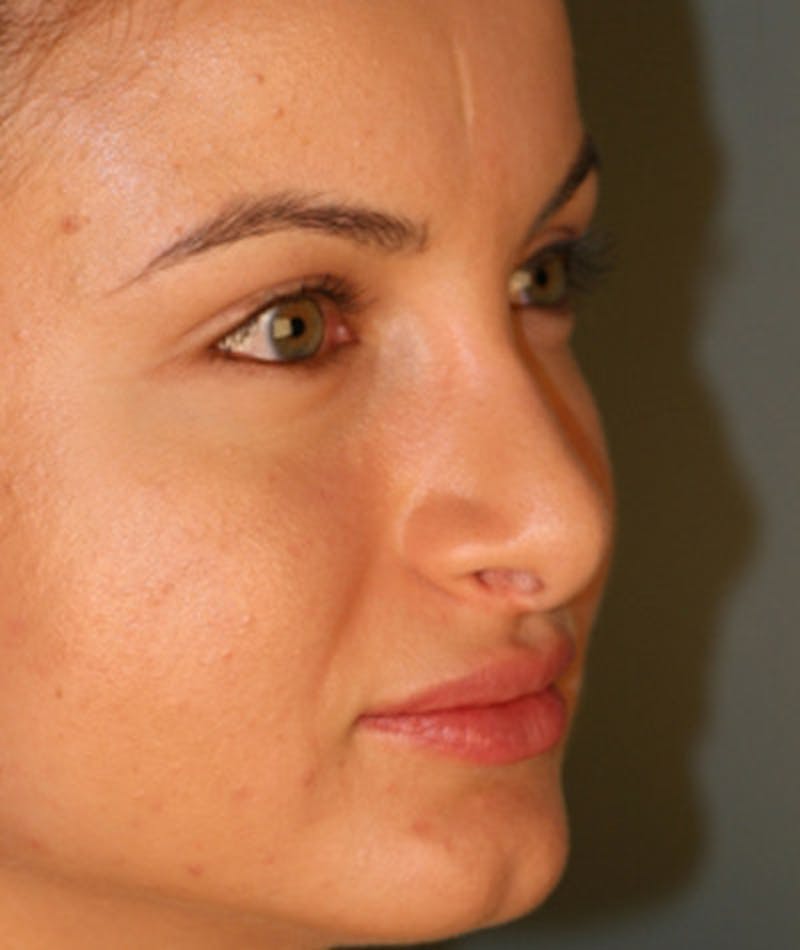 Revision Rhinoplasty Before & After Gallery - Patient 108191517 - Image 5