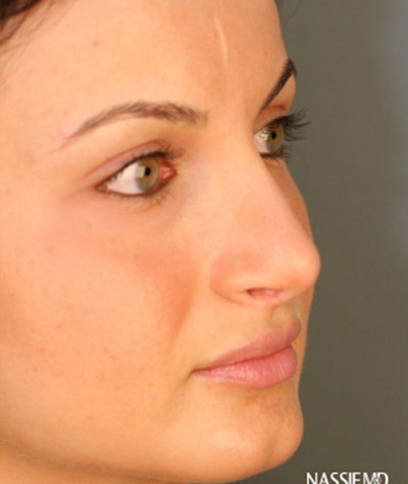 Revision Rhinoplasty Before & After Gallery - Patient 108191517 - Image 6