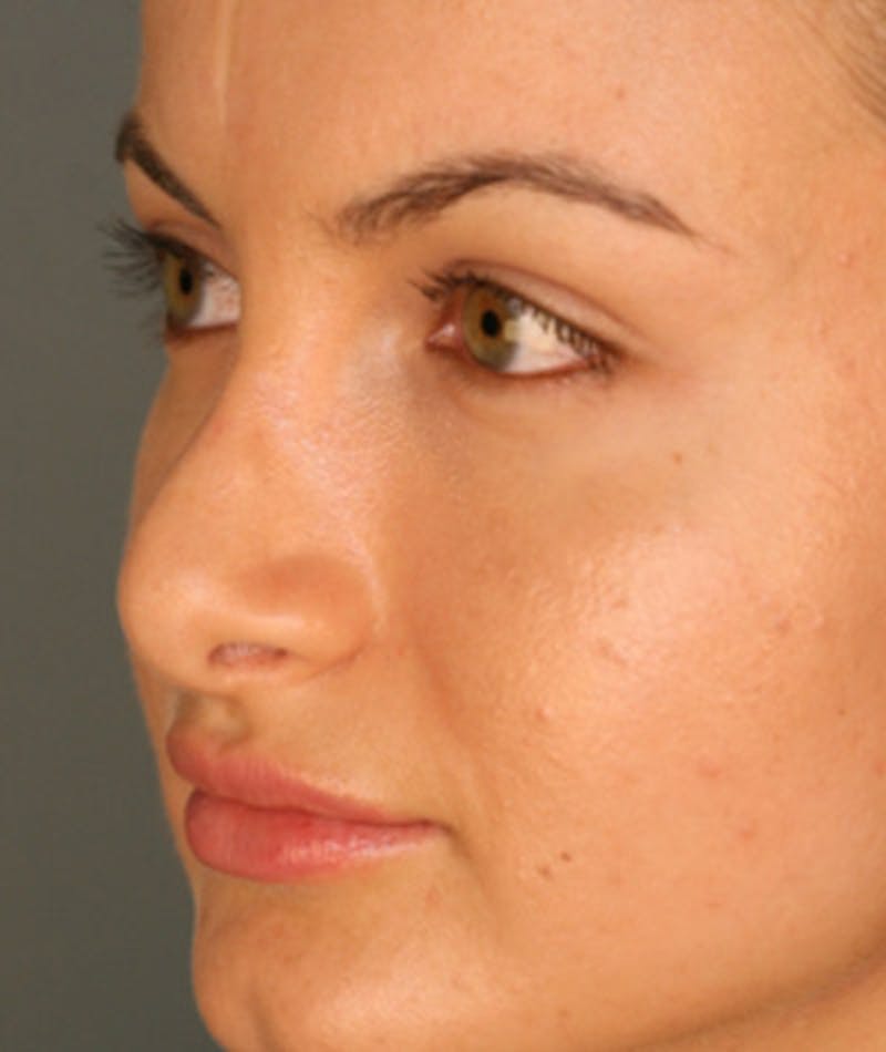 Revision Rhinoplasty Before & After Gallery - Patient 108191517 - Image 7