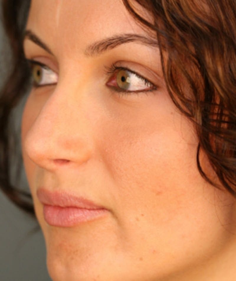 Revision Rhinoplasty Before & After Gallery - Patient 108191517 - Image 8