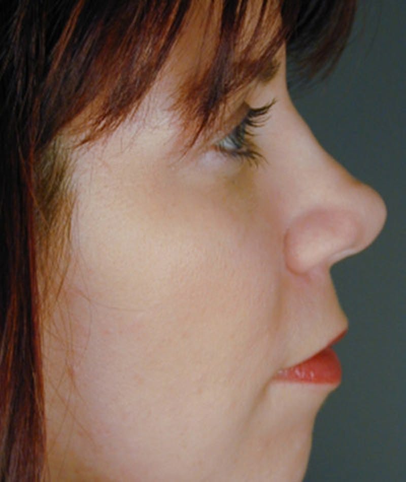 Revision Rhinoplasty Before & After Gallery - Patient 108191519 - Image 1