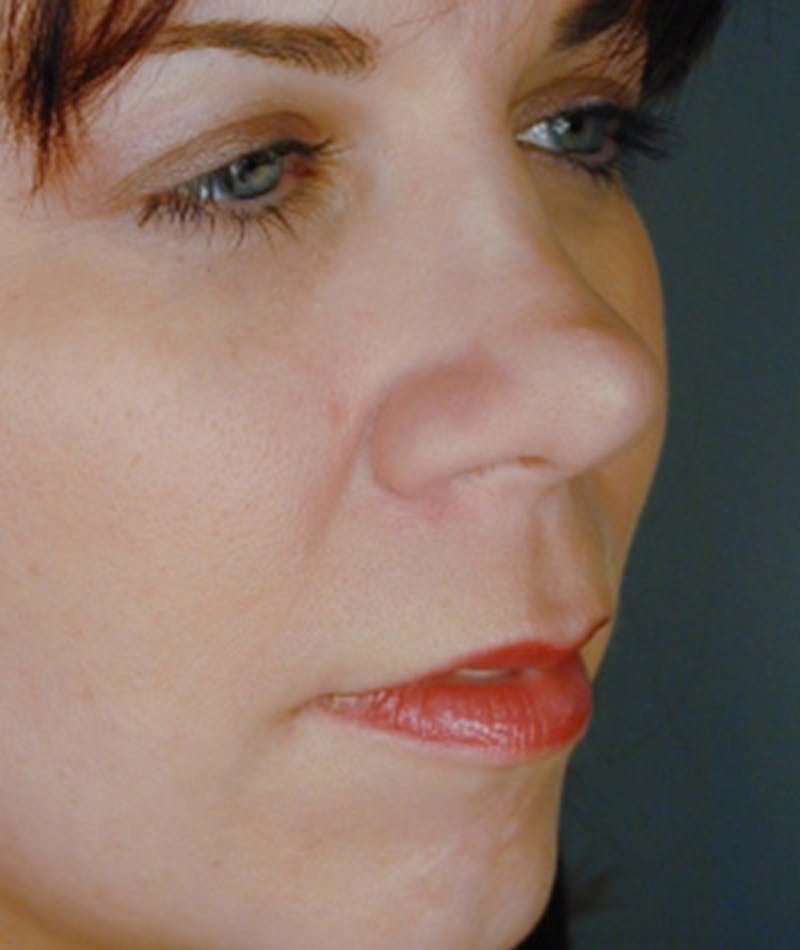 Revision Rhinoplasty Before & After Gallery - Patient 108191519 - Image 3