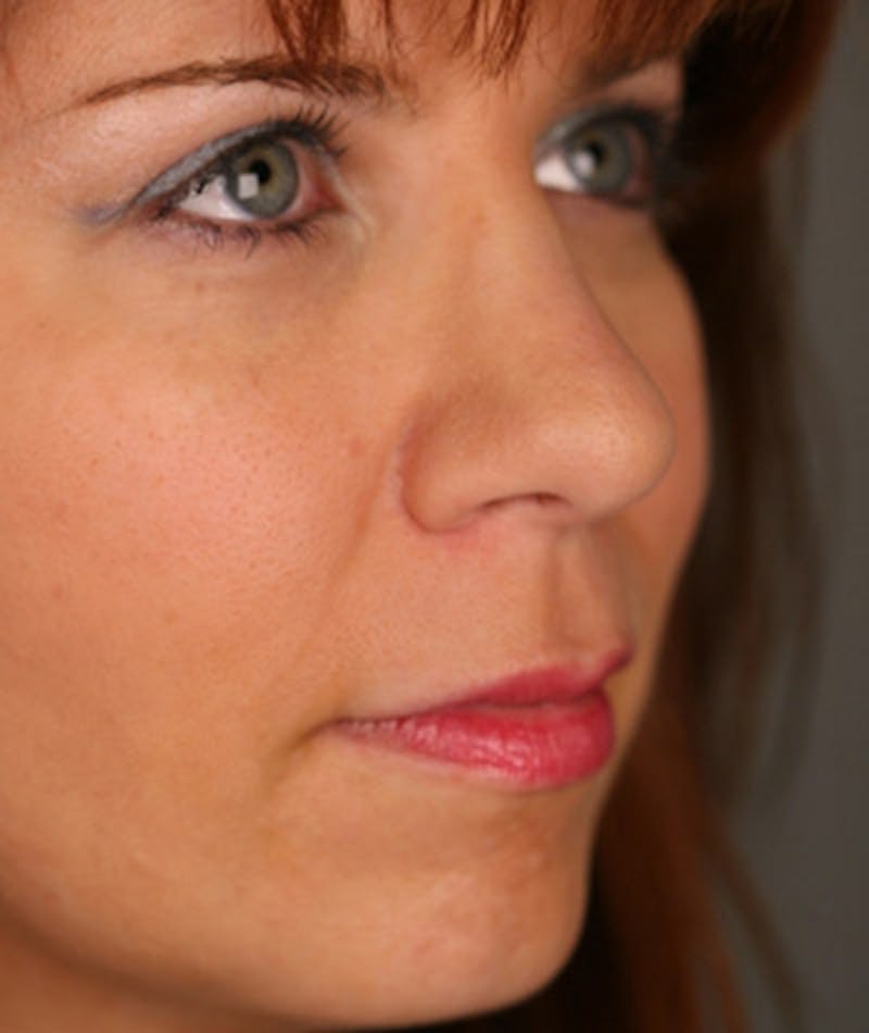 Revision Rhinoplasty Gallery - Patient 108191519 - Image 4