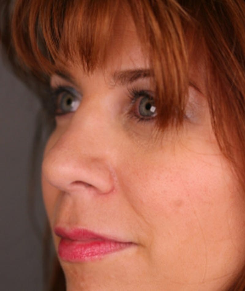 Revision Rhinoplasty Before & After Gallery - Patient 108191519 - Image 6