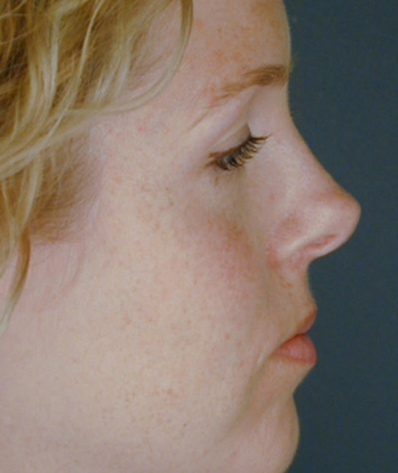 Revision Rhinoplasty Before & After Gallery - Patient 108191526 - Image 1