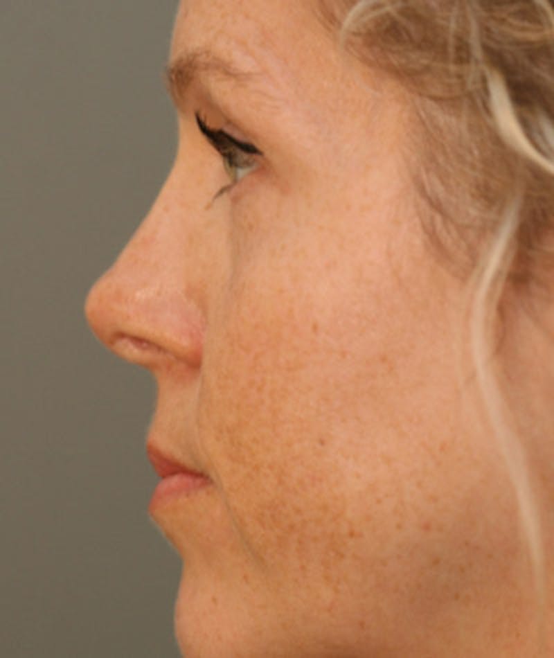 Revision Rhinoplasty Before & After Gallery - Patient 108191526 - Image 2
