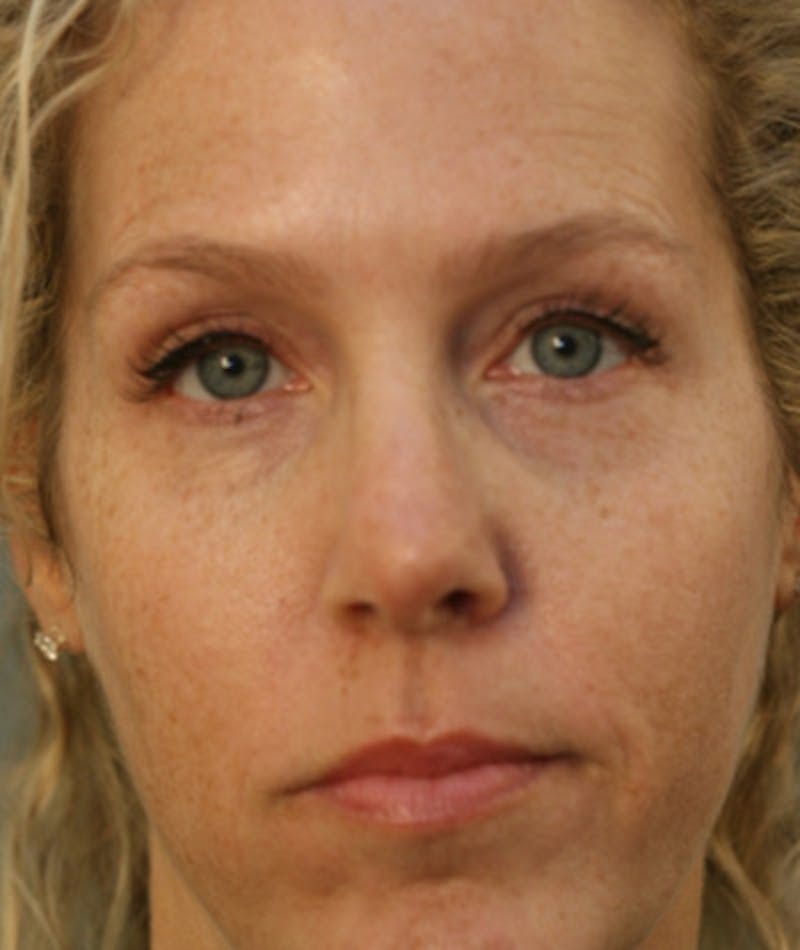 Revision Rhinoplasty Before & After Gallery - Patient 108191526 - Image 4
