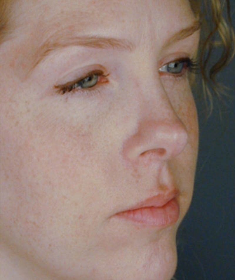 Revision Rhinoplasty Gallery - Patient 108191526 - Image 5