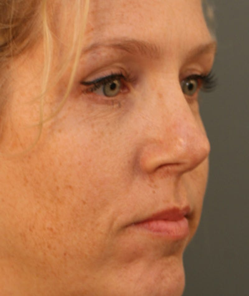 Revision Rhinoplasty Before & After Gallery - Patient 108191526 - Image 6