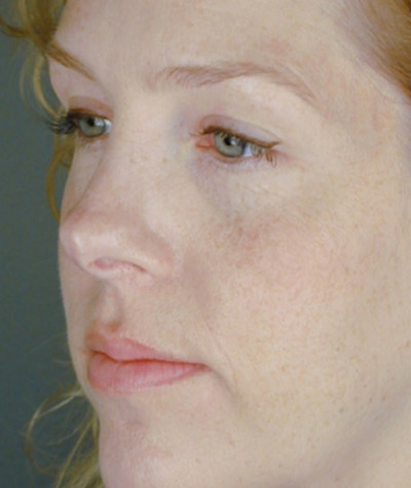 Revision Rhinoplasty Before & After Gallery - Patient 108191526 - Image 7