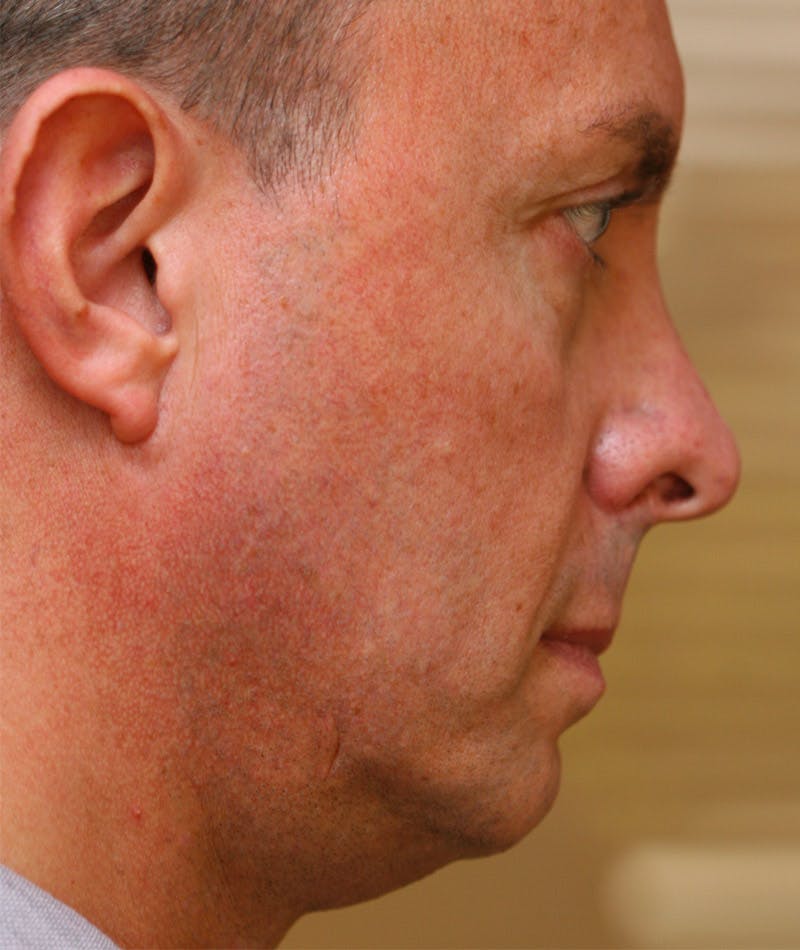 Revision Rhinoplasty Gallery - Patient 108191533 - Image 1